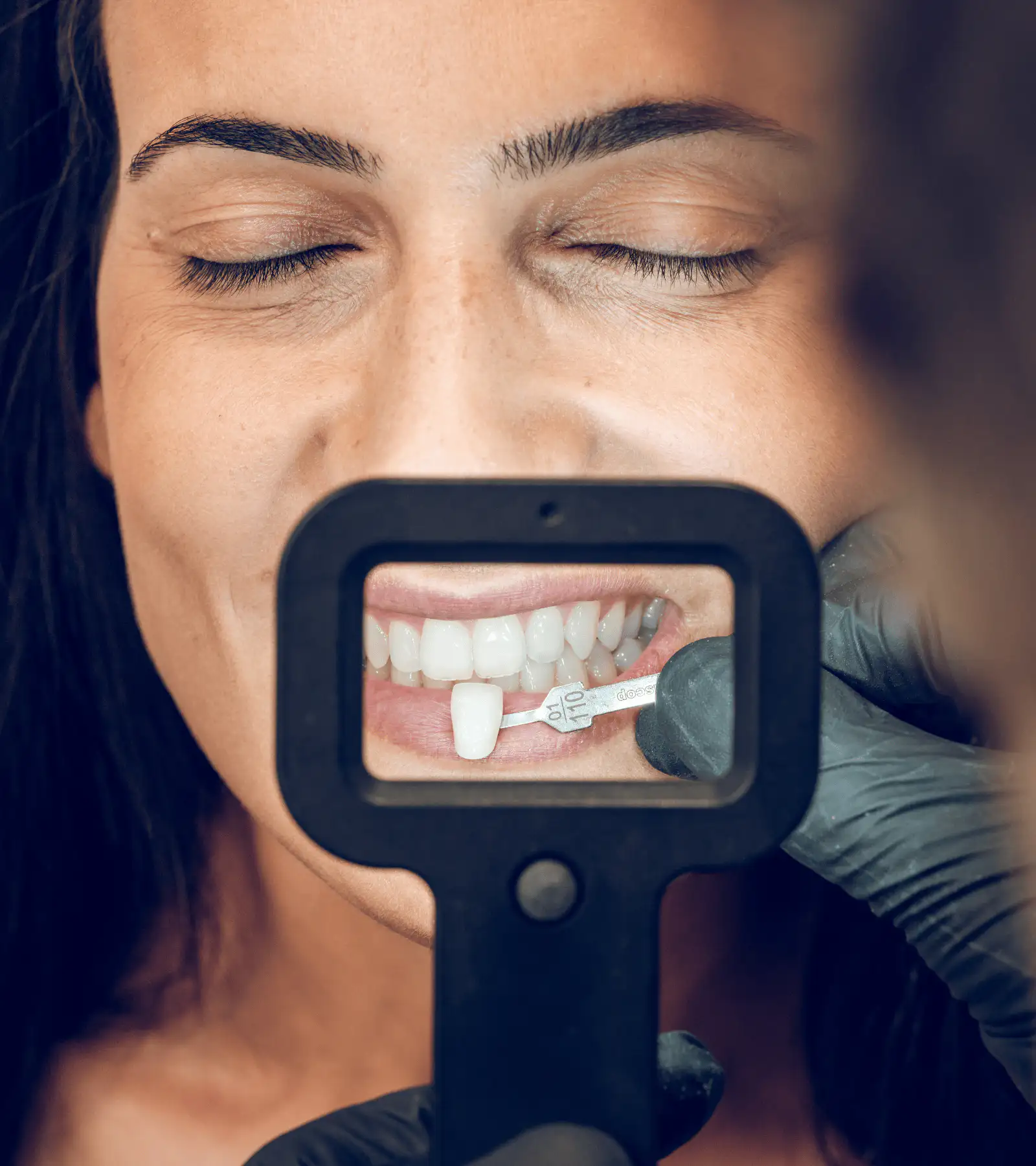 Crowns & Veneers in Delray Beach