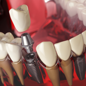 Dental Implant